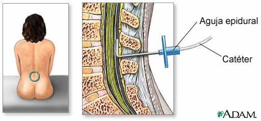 epidural