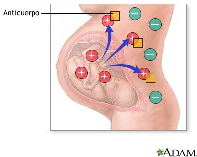 Factor Rh y embarazo