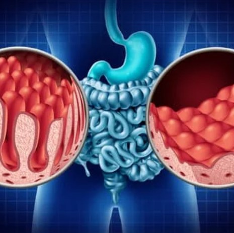 Celiaquía ¿Afecta a la Fertilidad y al Embarazo?