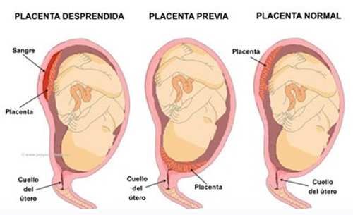 desprendimiento placenta