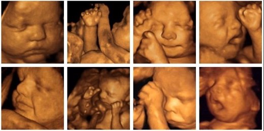 embarazo ecos ultrasonidos