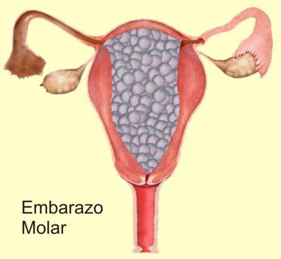 embarazo molar