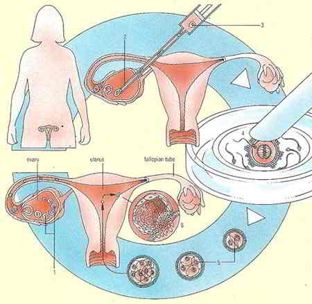 fecundacion in vitro