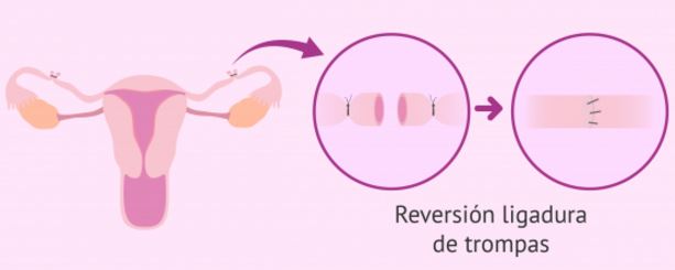 ligadura trompas reversion