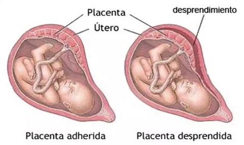 peligros desprendimiento placenta