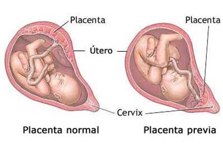 placenta previa procedimiento