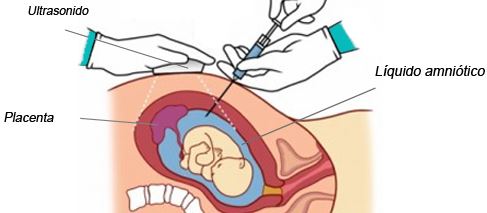 riesgos complicaciones amniocentesis