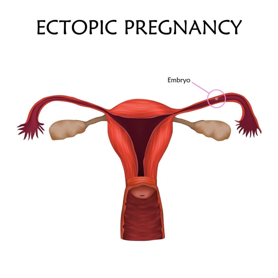 Síntomas de rotura del embarazo ectópico