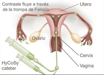 Trompas de Falopio e Infertilidad